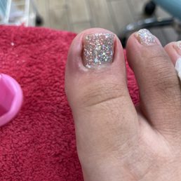 Bruised big toe
