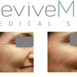 ReviveMD - 12 Units Botox Cosmetic applied to the Crow's Feet.  Perfect results seen 14 days later.