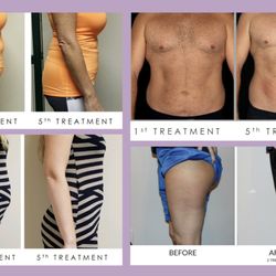 Coolsculpting