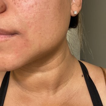 Skin Renewal Center - My skin super bumpy and red after the facial - Laser Hair Removal Near Me - Davis, California Skin Renewal Center - My skin super bumpy and red after the facial - Laser Hair Removal Near Me - Davis, California