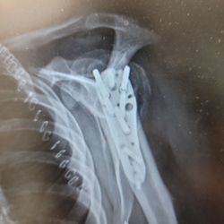 David Privitera, MD - Fixed left humorous immediately post surgery