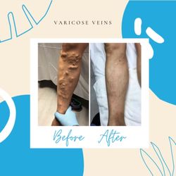 Afzal Clinics - Edina - Varicose veins