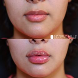 Feel confident and beautiful with Juvéderm Ultra! Get the perfect pout you've been dreaming of and take your look to the next level!
