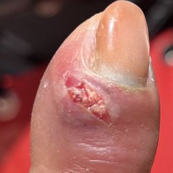 City Nails - Infection from snipped cuticle