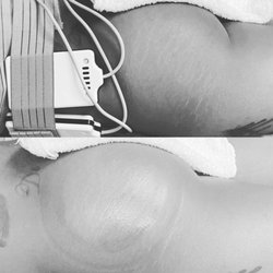 Makarios Body Lounge - Laser Lipo with Butt Therapy aka Non-Invasive BBL
