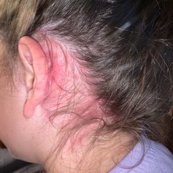 Premier Pediatrics - WUCA - Rash