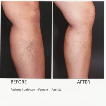 Fox Valley Vein Centers - Before & After - Vascular Medicine Near Me - Sandwich, Illinois Fox Valley Vein Centers - Before & After - Vascular Medicine Near Me - Sandwich, Illinois