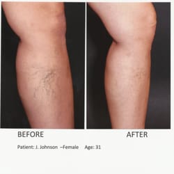 Fox Valley Vein Centers - Before & After