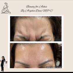 Beauty for ashes - Botox fillers