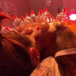 Healthy Healing Acupuncture Ashburn - Cupping