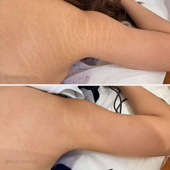 Markless Beauty - Stretch marks camouflage - Tattoo Near Me - Hallandale , Florida Markless Beauty - Stretch marks camouflage - Tattoo Near Me - Hallandale , Florida
