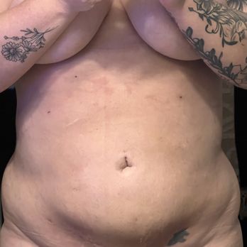 Sono Bello - One month post op. I have hip dips now that I did not have before. - Cosmetic Surgeons Near Me - Orlando, Florida