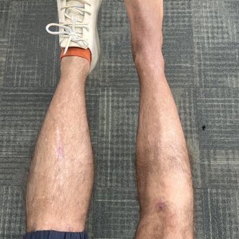 Ross H. Talarico, DPM - After cast removal - Orthopedists Near Me - Oakland, California Ross H. Talarico, DPM - After cast removal - Orthopedists Near Me - Oakland, California