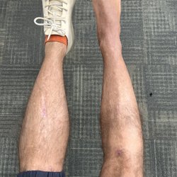 Ross H. Talarico, DPM - After cast removal