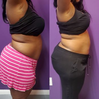 Mody Sculpt - Body Contouring Near Me Mody Sculpt - Body Contouring Near Me