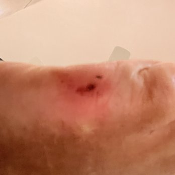 Milan Nails Spa - Cut still angry almost 24 hours later! - Nail Salons Near Me - Westlake Village, California Milan Nails Spa - Cut still angry almost 24 hours later! - Nail Salons Near Me - Westlake Village, California
