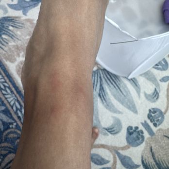 Grand Wailea, A Waldorf Astoria Resort - Bed bug bites from hotel - Hotels Near Me - Wailea, Hawaii