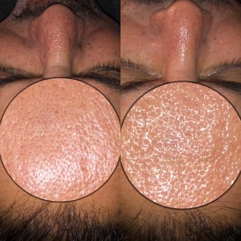 Janoir Skin and Lash - Essential Facial: before/after - Skin Care Near Me Janoir Skin and Lash - Essential Facial: before/after - Skin Care Near Me