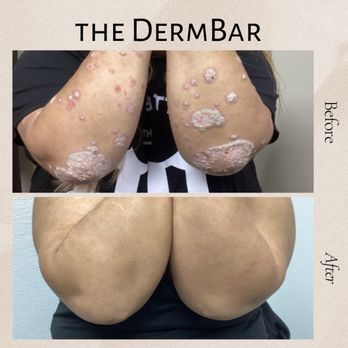 The DermBar - Psoriasis - Dermatologists Near Me - Ontario, California
