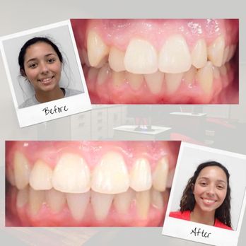 Red Leaf Orthodontics - Before and After - Great results improving crowding and crossbite. - Orthodontists Near Me - Ooltewah, Tennessee Red Leaf Orthodontics - Before and After - Great results improving crowding and crossbite. - Orthodontists Near Me - Ooltewah, Tennessee