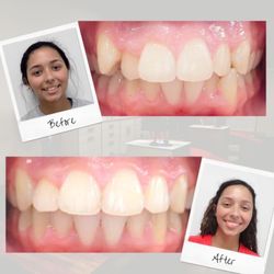 Red Leaf Orthodontics - Before and After - Great results improving crowding and crossbite.