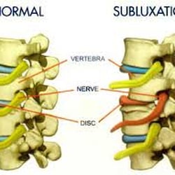 Franhill Chiropractic Life Center - Subluxation