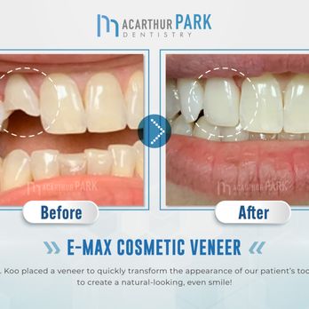 MacArthur Park Dentistry - MacArthur Park Dentistry Emergency, Invisalign, Implant | Call: (972)831-9600 - General Dentistry Near Me - Irving, Texas MacArthur Park Dentistry - MacArthur Park Dentistry Emergency, Invisalign, Implant | Call: (972)831-9600 - General Dentistry Near Me - Irving, Texas