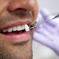 Gulch Cosmetic Dentistry - veneers