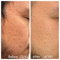 Liway Acupuncture Clinic - Microneedling treatment before and after