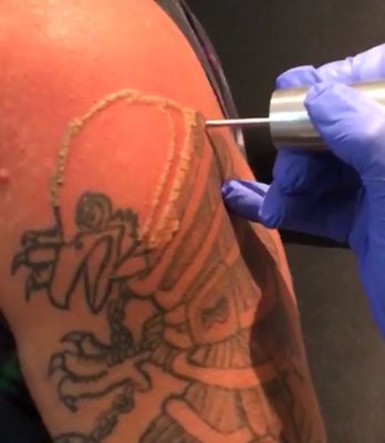 VANISH-INK LASER TATTOO REMOVAL - Updated January 2025 - 23 Reviews - 310 East Blvd, Charlotte