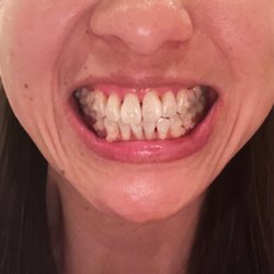 Los Altos Orthodontics - Tray #12