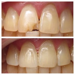 Artisan Dentistry - Custom shade and layering of composite can give a natural outcome.