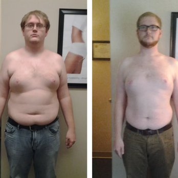 Slimline Solutions - Weight loss results - Body Contouring Near Me - Los Angeles, California Slimline Solutions - Weight loss results - Body Contouring Near Me - Los Angeles, California