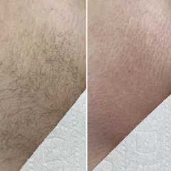 Perfectly Bare Wax Bar - Brazilian Wax Before & After