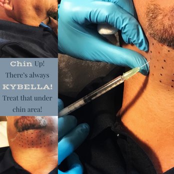 Urenewed - First non-surgical treatment used for the permanent removal of chin fat under the neck area! - Medical Spas Near Me - Ripon, California