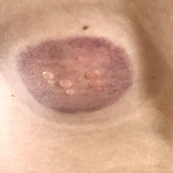 Khloe Wilson, LMT - Tranquility Life - Blisters formed on my back one week after the fire cupping - Massage Near Me - Crystal Lake, Illinois Khloe Wilson, LMT - Tranquility Life - Blisters formed on my back one week after the fire cupping - Massage Near Me - Crystal Lake, Illinois