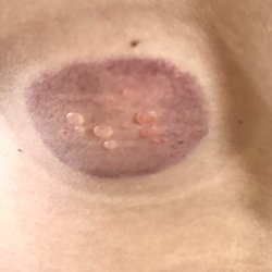 Blisters formed on my back one week after the fire cupping
