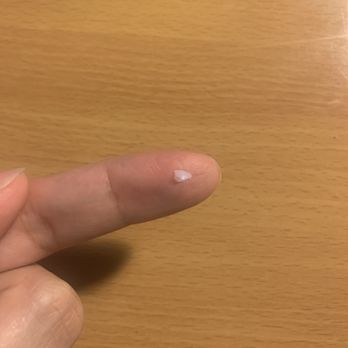 Ng Linda L DDS - My chipped piece of tooth I could've swallowed. Fell off when I was eating bread. - Oral Surgeons Near Me - Arcadia, California Ng Linda L DDS - My chipped piece of tooth I could've swallowed. Fell off when I was eating bread. - Oral Surgeons Near Me - Arcadia, California