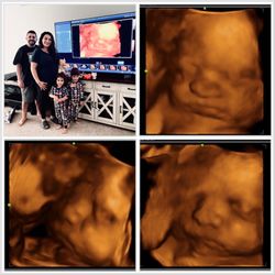 Babyvue 3D/4D ultrasound
