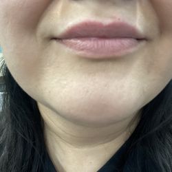 Beauty Drip Medspa - Lip flip