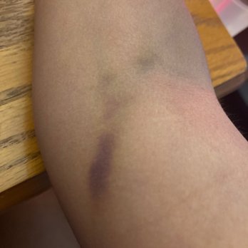 Quest Diagnostics - The image depicts a person's leg with several bruises of different shades, including purple and green, indicating recent or healing injuries. The leg is positioned on a wooden surface, possibly a table or countertop, with a background that includes a container with a lid and some red and white objects. The skin appears to be covered with sheer, dark-colored tights or stockings. - Laboratory Testing Near Me - Peekskill, New York