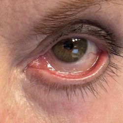 Eyelid detached