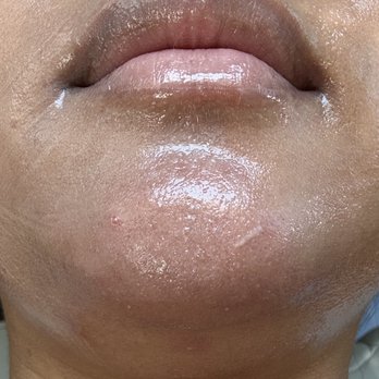 Sahar's Beauty Touch - after 1st treatment - Skin Care Near Me - La Mesa, California Sahar's Beauty Touch - after 1st treatment - Skin Care Near Me - La Mesa, California