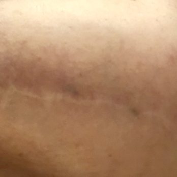 San Diego Body Contouring - Close up of more stitches and jagged scarring - Cosmetic Surgeons Near Me - San Diego, California San Diego Body Contouring - Close up of more stitches and jagged scarring - Cosmetic Surgeons Near Me - San Diego, California