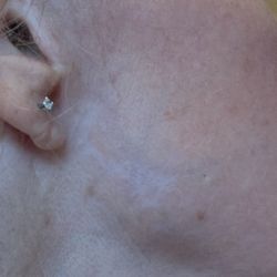 Trieu Dermatology - After Dr. Trieu's care I was left with this permanent scar along my jaw line starting at my ear.