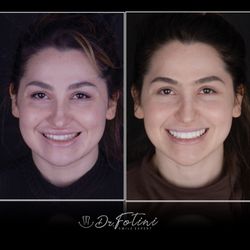 Fotini Chrisopoulos DDS, MS - Smile makeover with porcelain restorations for this beautiful patient who wanted to restore balance and symmetry to her smile.