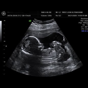 First Look Ultrasound - Baby boy is comfy in there - Diagnostic Imaging Near Me - Kaneohe, Hawaii