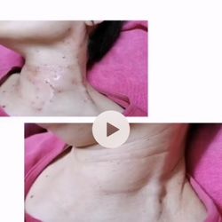 Jessie Skincare - remove the Naevus carnosus激光點肉痣