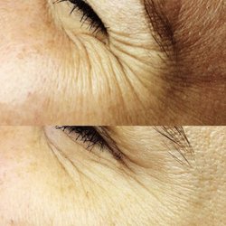 Elle Aesthetics - Just a few units of Botox can really decrease smile lines and crows feet.