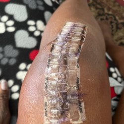 Andrew Martin - Left Total Knee Replacement
